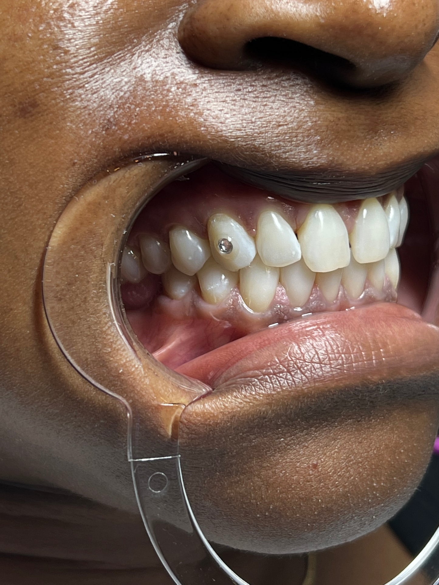 90 Minute Teeth Whitening + 1 Gem
