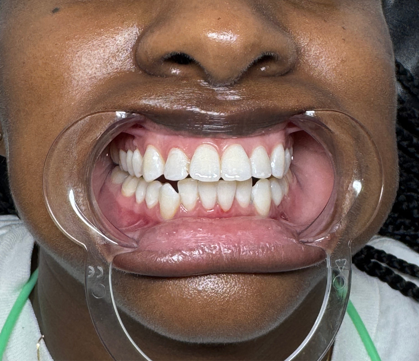 Cheek Retractor