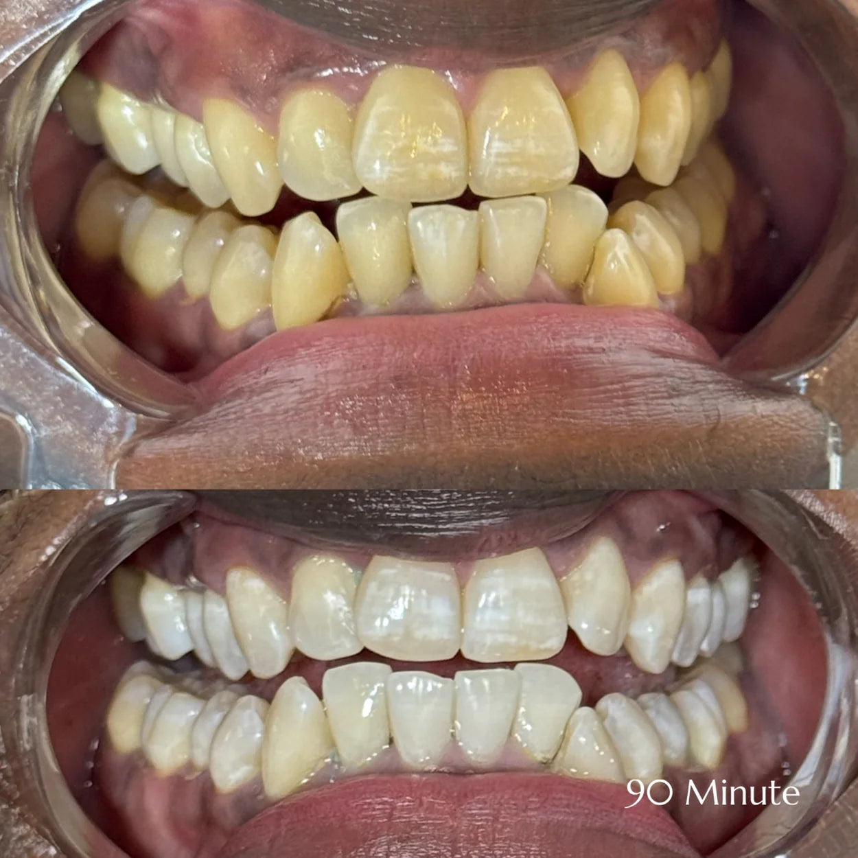 90 Minute Teeth Whitening