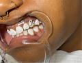 Discoball tooth gem