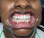 Cheek Retractor