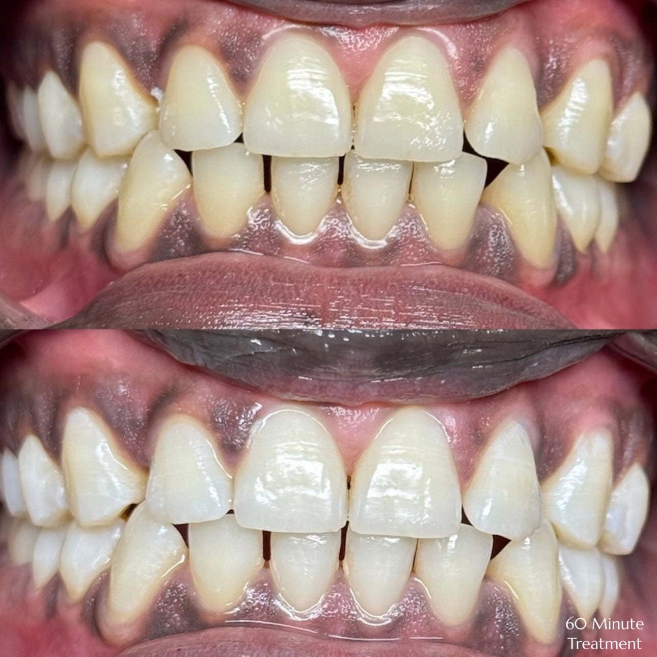 60 Minute Whitening Session
