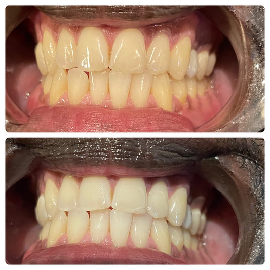 Before and after results of Grin & Glow’s 30-minute professional teeth whitening service showing visibly whiter, brighter teeth in one session.Before and after teeth whitening results at Grin & Glow in Rochester NY showing visibly brighter smile after one treatment using vegan-friendly whitening gel