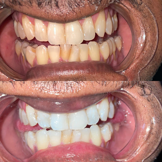 Before and after results of Grin & Glow’s 60-minute professional teeth whitening service showing visibly whiter, brighter teeth in one session. Before and after results of Grin & Glow’s 30-minute professional teeth whitening service showing visibly whiter, brighter teeth in one session.Before and after teeth whitening results at Grin & Glow in Rochester NY showing visibly brighter smile after one treatment using vegan-friendly whitening gel