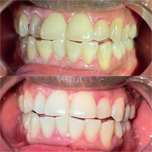 Before and after results of Grin & Glow’s 90-minute professional teeth whitening service showing visibly whiter, brighter teeth in one session. Before and after results of Grin & Glow’s 30-minute professional teeth whitening service showing visibly whiter, brighter teeth in one session.Before and after teeth whitening results at Grin & Glow in Rochester NY showing visibly brighter smile after one treatment using vegan-friendly whitening gel