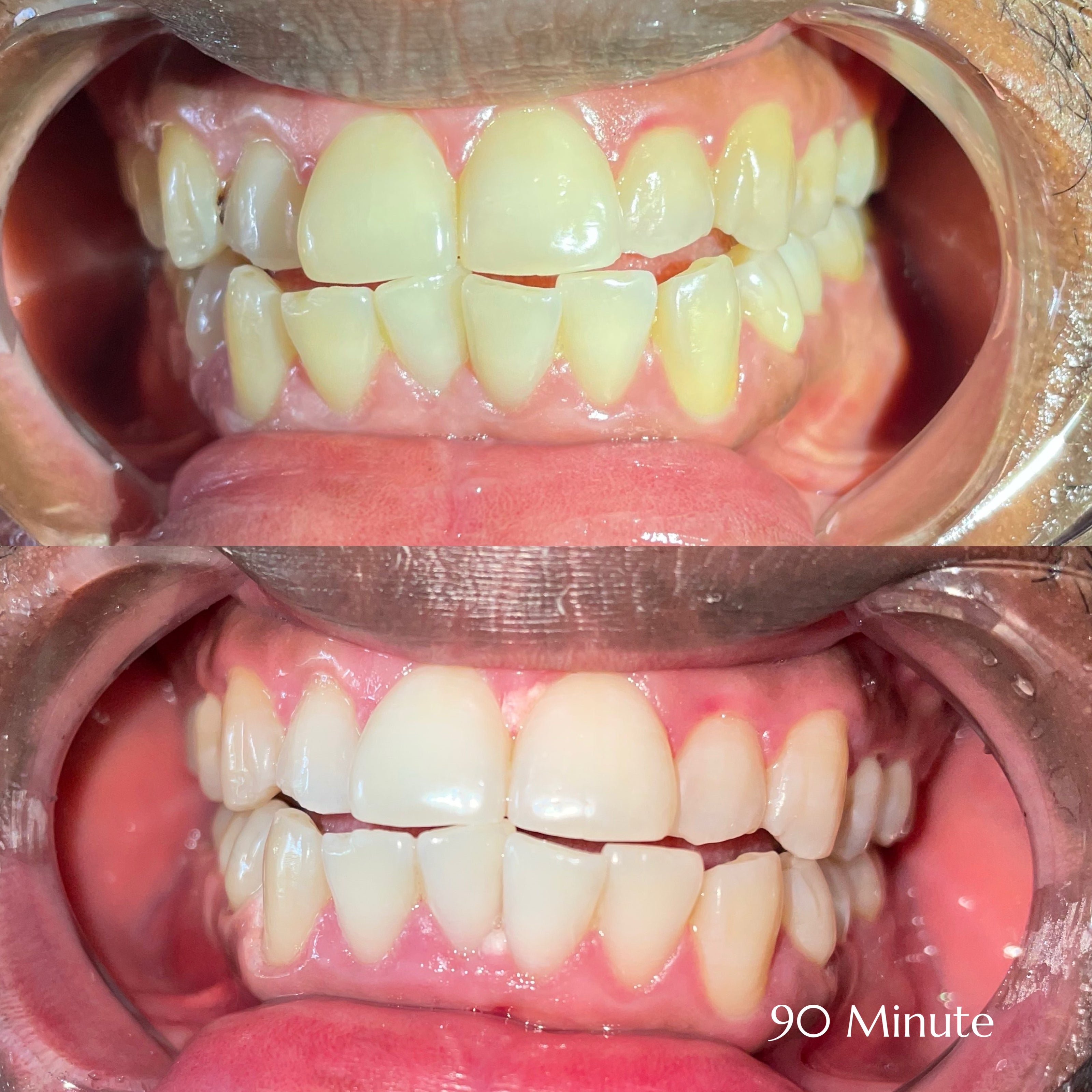 Before and after teeth whitening results at Grin & Glow in Rochester NY showing visibly brighter smile after one treatment using vegan-friendly whitening gel