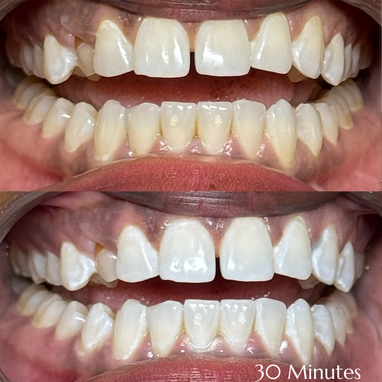 Before and after teeth whitening results at Grin & Glow in Rochester NY showing visibly brighter smile after one treatment using vegan-friendly whitening gel