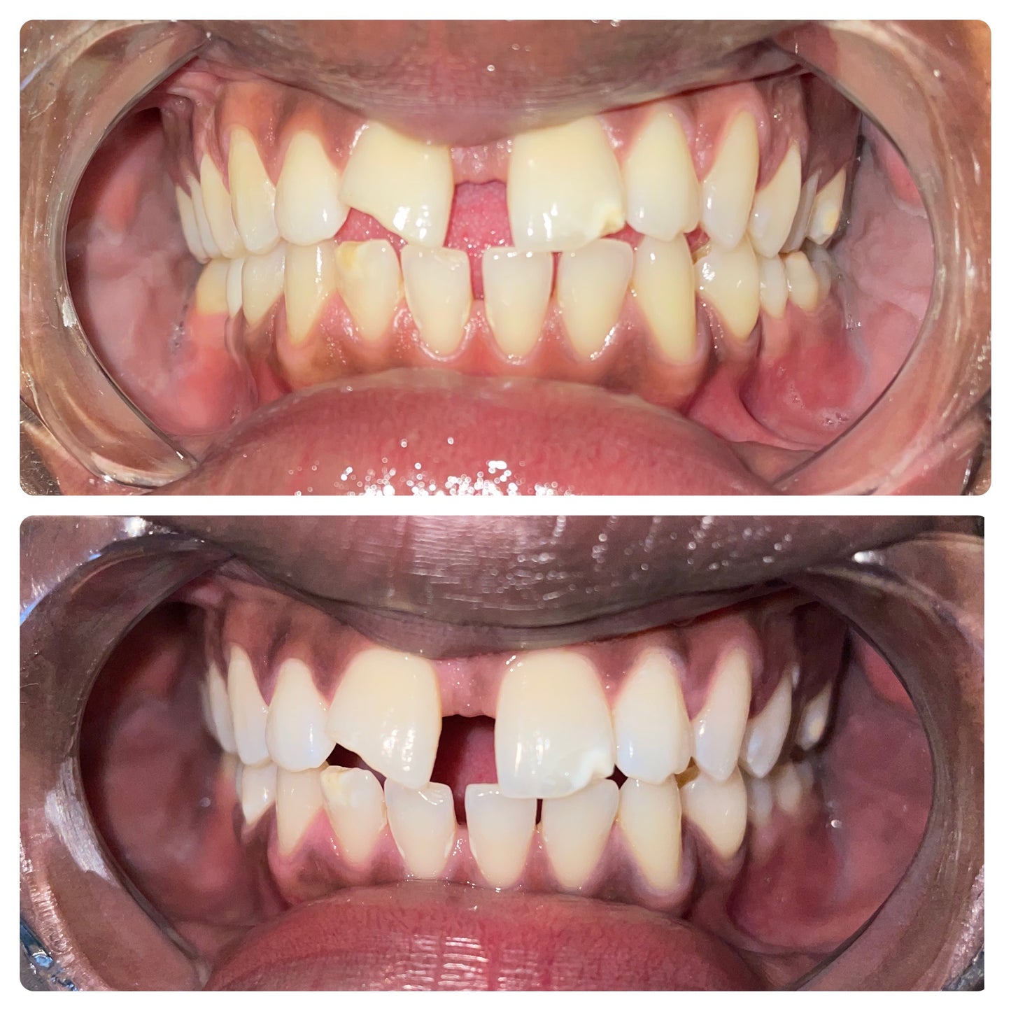 Couples teeth whitening session at Grin & Glow featuring a side-by-side treatment experience with visible results for both partners in one visit. Before and after results of Grin & Glow’s 30-minute professional teeth whitening service showing visibly whiter, brighter teeth in one session.Before and after teeth whitening results at Grin & Glow in Rochester NY showing visibly brighter smile after one treatment using vegan-friendly whitening gel