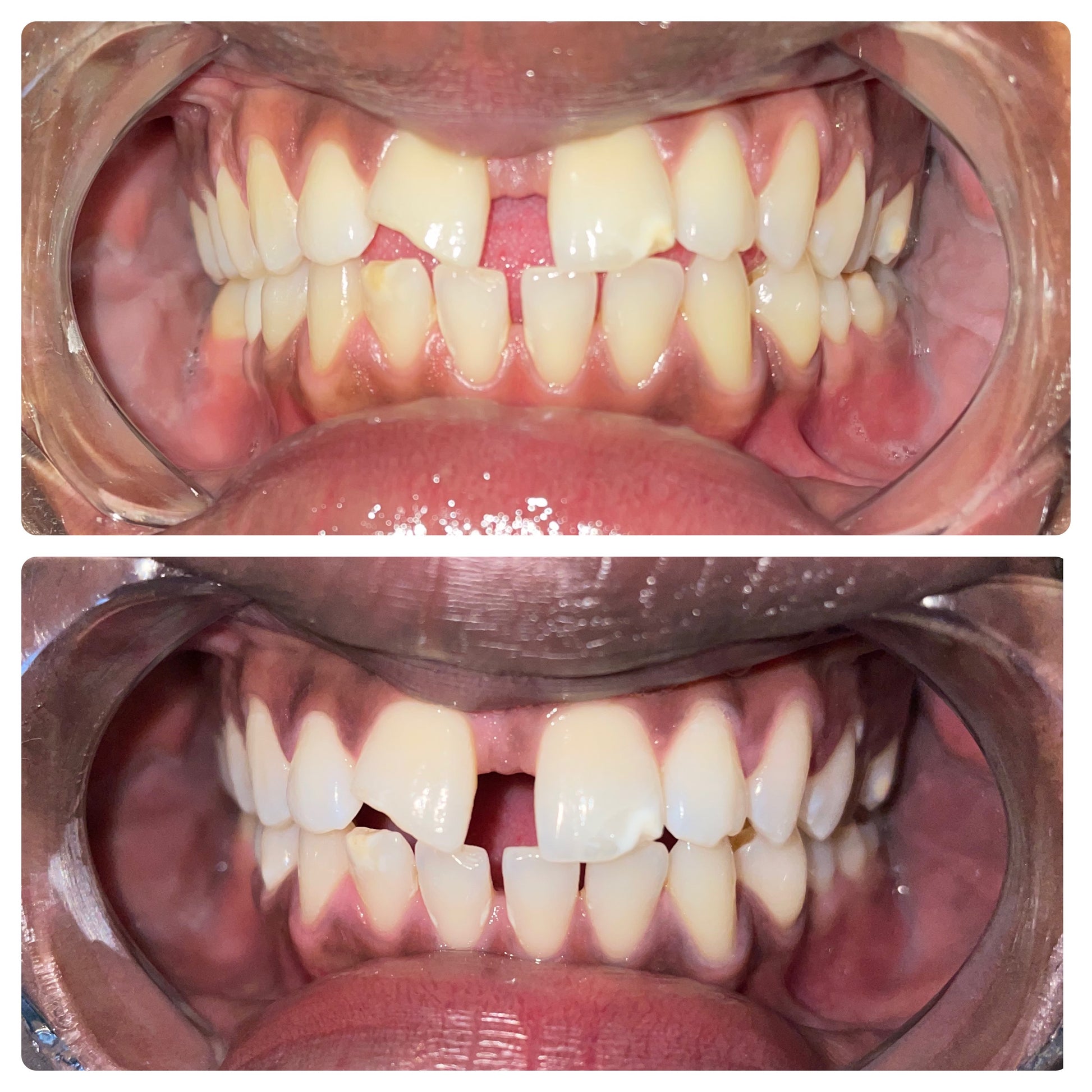 Couples teeth whitening session at Grin & Glow featuring a side-by-side treatment experience with visible results for both partners in one visit. Before and after results of Grin & Glow’s 30-minute professional teeth whitening service showing visibly whiter, brighter teeth in one session.Before and after teeth whitening results at Grin & Glow in Rochester NY showing visibly brighter smile after one treatment using vegan-friendly whitening gel