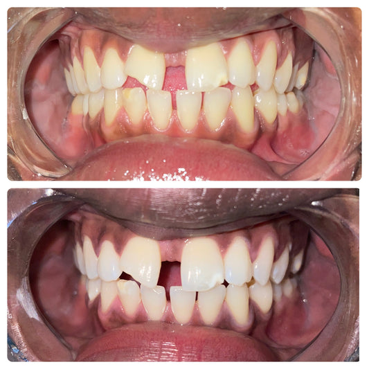 Couples teeth whitening session at Grin & Glow featuring a side-by-side treatment experience with visible results for both partners in one visit. Before and after results of Grin & Glow’s 30-minute professional teeth whitening service showing visibly whiter, brighter teeth in one session.Before and after teeth whitening results at Grin & Glow in Rochester NY showing visibly brighter smile after one treatment using vegan-friendly whitening gel
