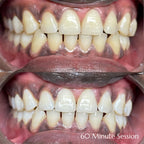 60 Minute Teeth Whitening + 1 Gem