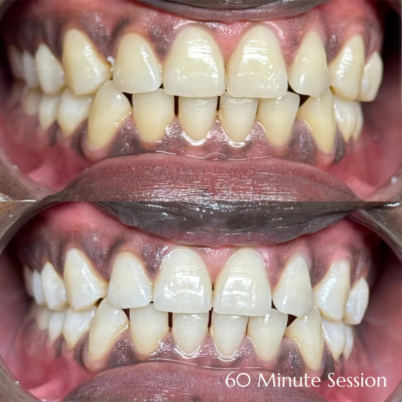 60 Minute Teeth Whitening + 1 Gem