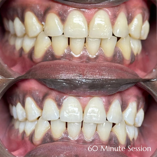 60 Minute Teeth Whitening + 1 Gem