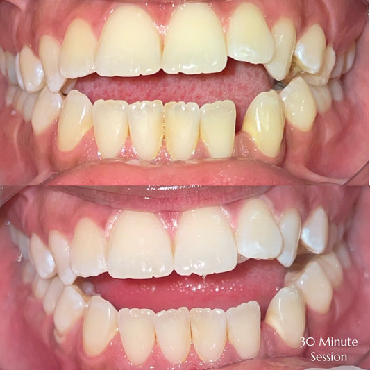 30 Minute Whitening Session