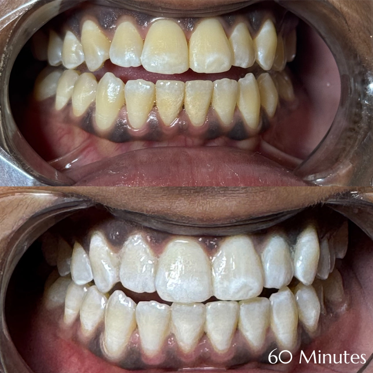 Before and after teeth whitening results at Grin & Glow in Rochester NY showing visibly brighter smile after one treatment using vegan-friendly whitening gel