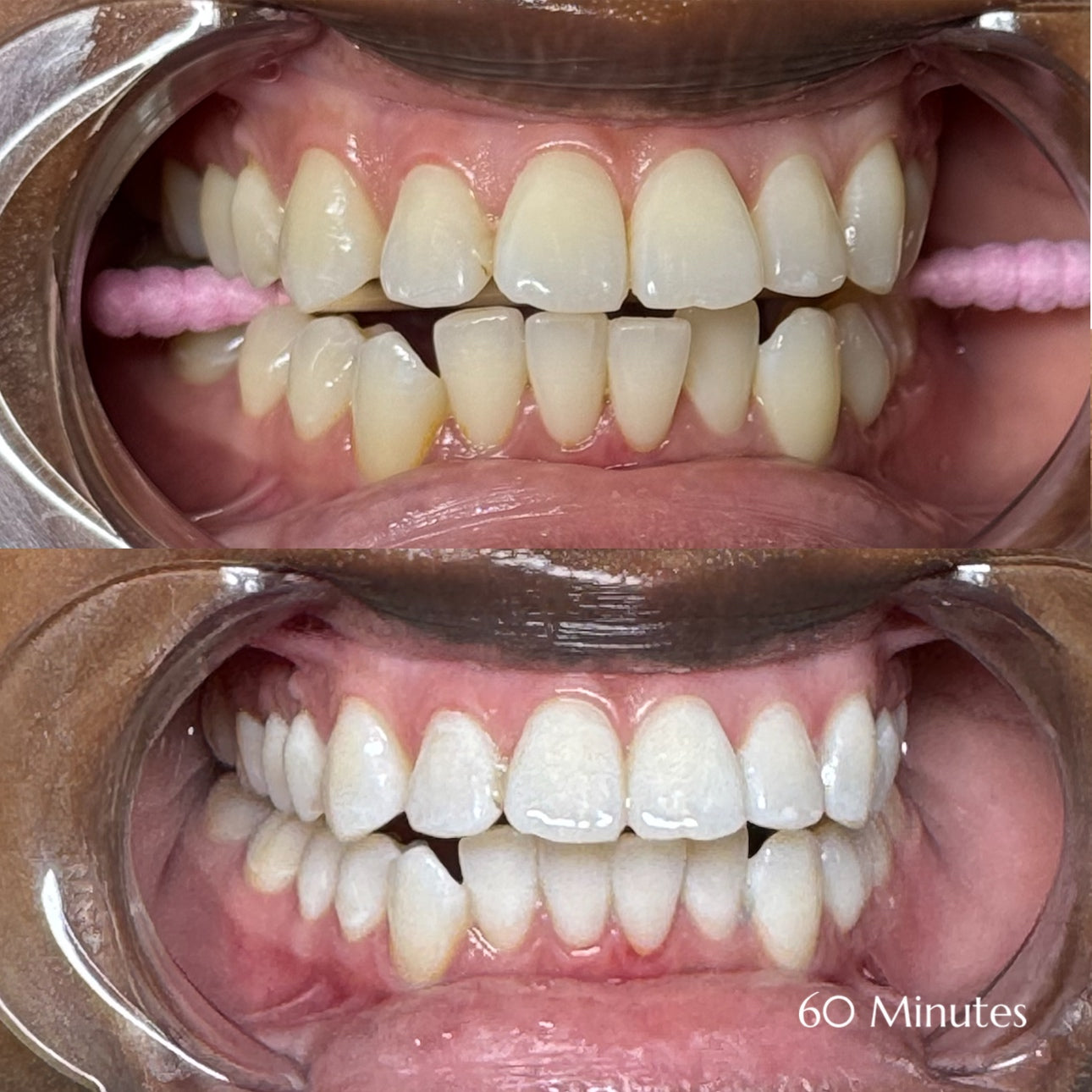 Before and after teeth whitening results at Grin & Glow in Rochester NY showing visibly brighter smile after one treatment using vegan-friendly whitening gel