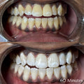 90 Minute Teeth Whitening