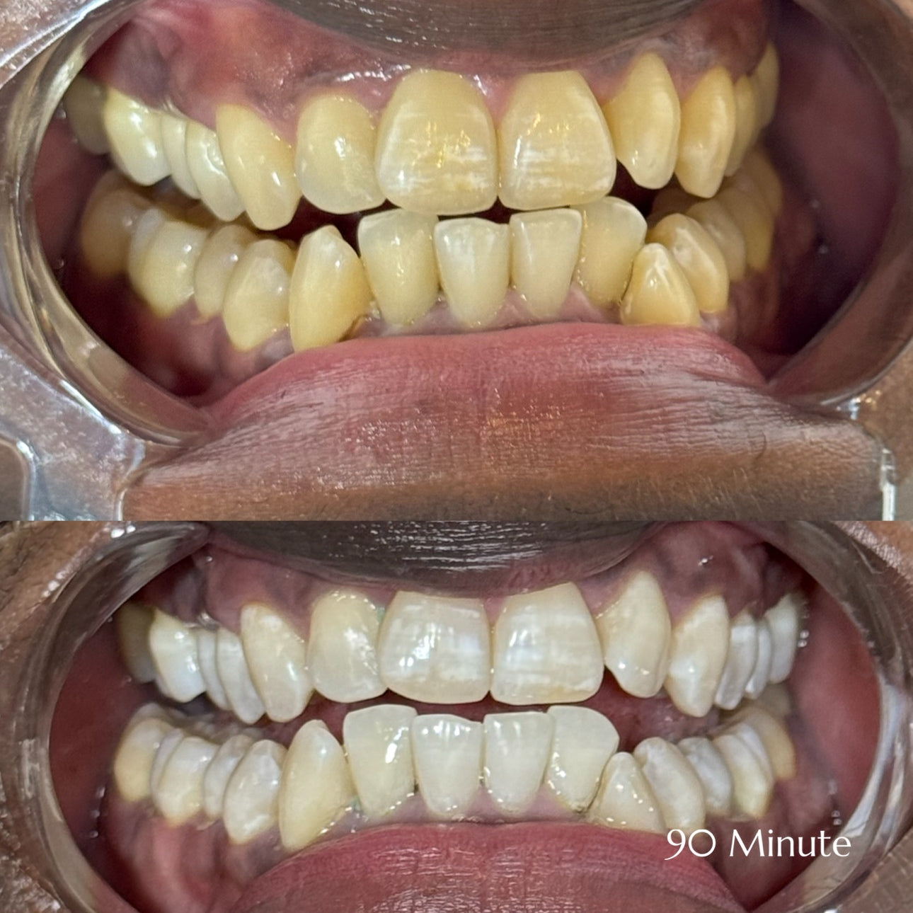 Before and after teeth whitening results at Grin & Glow in Rochester NY showing visibly brighter smile after one treatment using vegan-friendly whitening gel