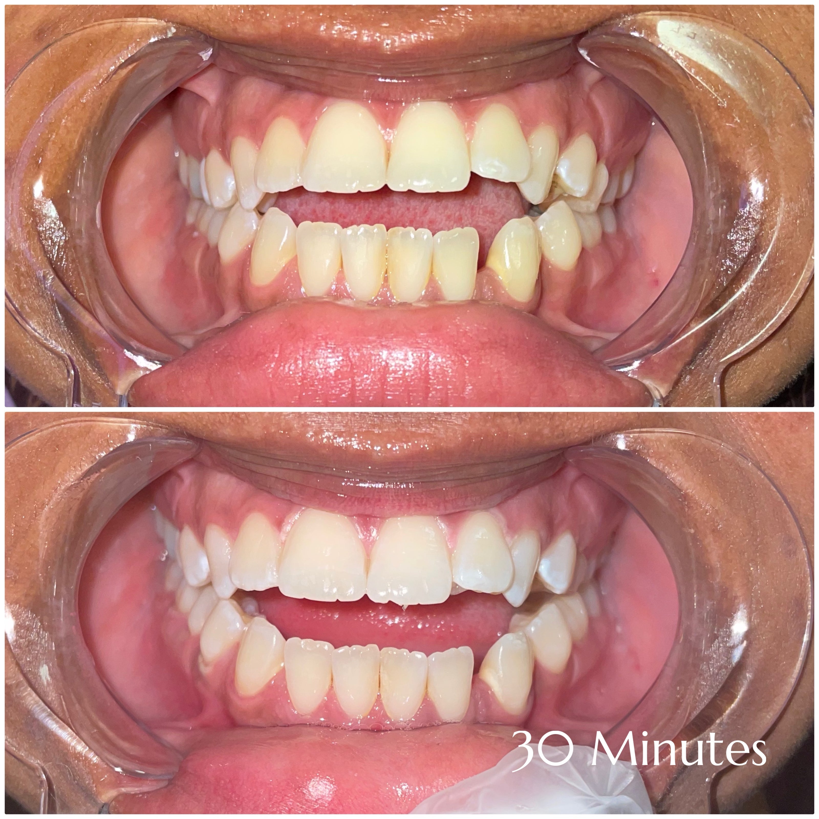 Before and after teeth whitening results at Grin & Glow in Rochester NY showing visibly brighter smile after one treatment using vegan-friendly whitening gel