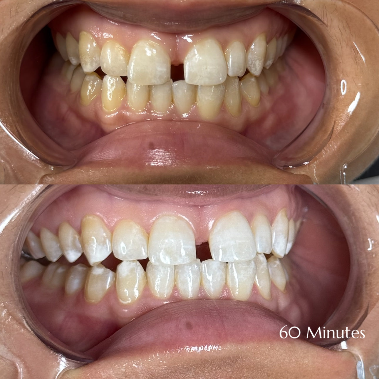 Before and after teeth whitening results at Grin & Glow in Rochester NY showing visibly brighter smile after one treatment using vegan-friendly whitening gel