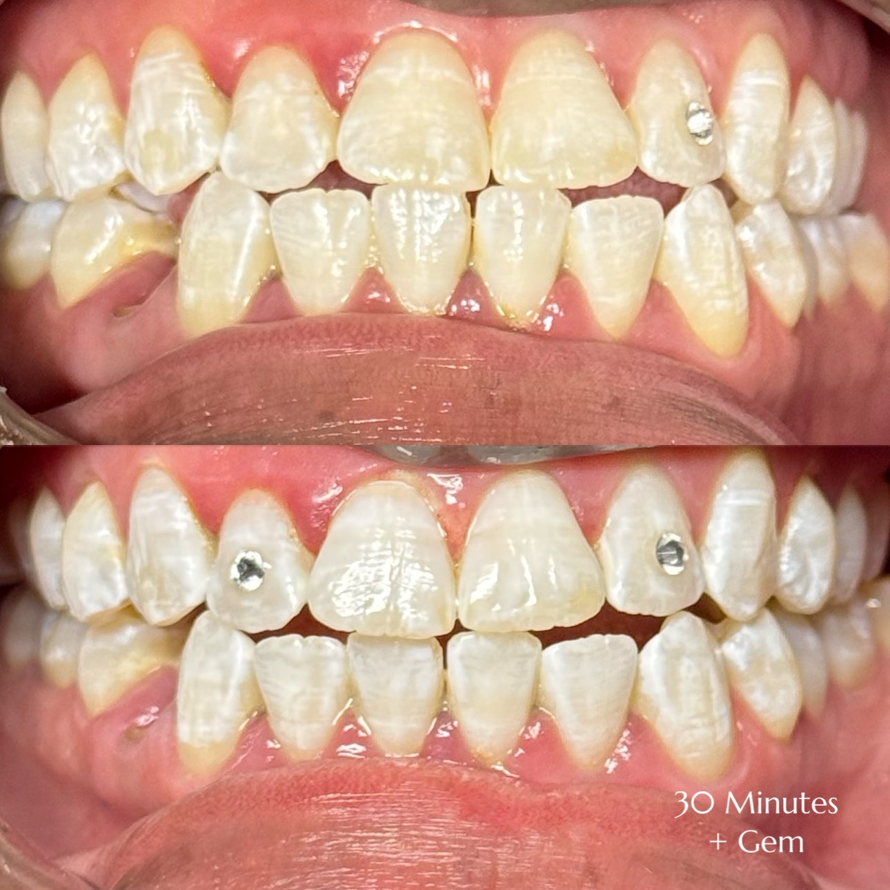 Before and after teeth whitening results at Grin & Glow in Rochester NY showing visibly brighter smile after one treatment using vegan-friendly whitening gel