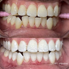 grin & glow teeth whitening Before and after comparison of teeth with a 60 Minutes label.